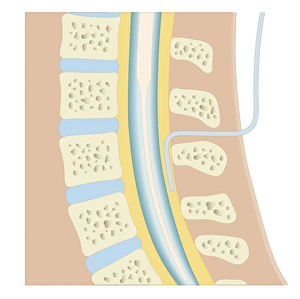 Cross section biomedical illustration of epidural anaesthesia during labour Cross section biomedical illustration of epidural anaesthesia during labour