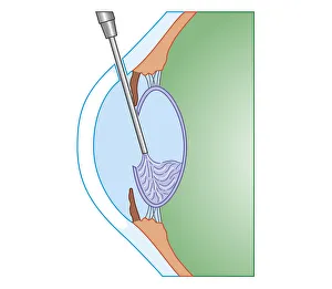 Cross section biomedical illustration of eye cataract surgery sucking softened tissue out Cross section biomedical illustration of eye cataract surgery sucking softened tissue out
