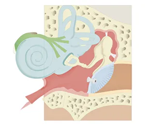 Cross section biomedical illustration of grommet inserted in eardrum (tympanic membrane) Cross section biomedical illustration of grommet inserted in eardrum (tympanic membrane)