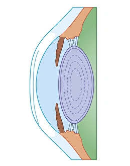 Cross section biomedical illustration of human eye before corrective surgery for myopia Cross section biomedical illustration of human eye before corrective surgery for myopia