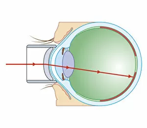 Laser Gallery: Cross section biomedical illustration of laser surgery for retinopathy