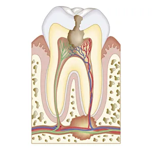 Cross section biomedical illustration of pulp and root abscess in molar Cross section biomedical illustration of pulp and root abscess in molar