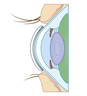 Cross section biomedical illustration of soft contact lens on eye Cross section biomedical illustration of soft contact lens on eye