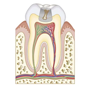 Cross section biomedical illustration of tooth decay before dental filling Cross section biomedical illustration of tooth decay before dental filling