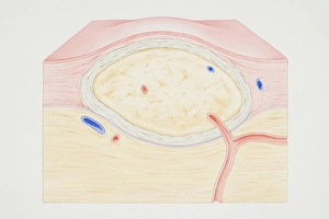 Cross-section diagram of a non-cancerous tumour including a fibrous capsule, tissue layer and blood vessel Cross-section diagram of a non-cancerous tumour including a fibrous capsule, tissue layer and blood vessel
