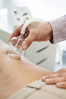 Cupping therapy, cupping glass on a patients back Cupping therapy, cupping glass on a patients back