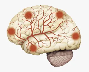 Digital illustration of human brain showing blood vessels, and areas of dead tissue highlighted in red Digital illustration of human brain showing blood vessels, and areas of dead tissue highlighted in red