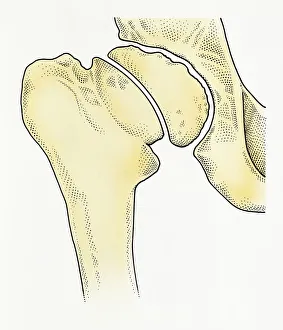 Digital illustration showing degeneration of hip joint known as Perthes disease Digital illustration showing degeneration of hip joint known as Perthes disease
