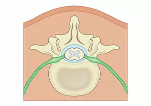 Vertebra Gallery: Digital illustration Spina Bifida, Meningocele, where protective covering around spinal cord