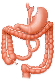 Biomedical Illustration Gallery: Gastric bypass procedure