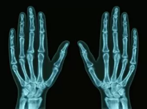 Images Dated 20th March 2013: Hands, X-ray