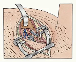 Illustration of abdominal incision between ribs kept open by spreaders exposing human Illustration of abdominal incision between ribs kept open by spreaders exposing human
