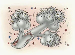 Illustration of bronchus and alveolus covered in inorganic particles, fibroblasts Illustration of bronchus and alveolus covered in inorganic particles, fibroblasts