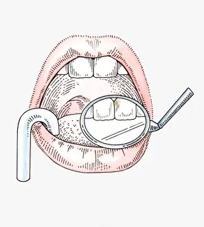 Illustration of dental examination using mirror and suction tube Illustration of dental examination using mirror and suction tube