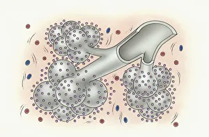 Illustration of development of idiopathic pulmonary fibrosis showing bronchus Illustration of development of idiopathic pulmonary fibrosis showing bronchus