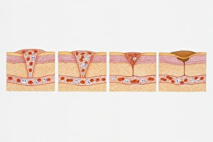 Illustration of formation of blood clot in series of four cross section illustrations showing blood oozing from blood Illustration of formation of blood clot in series of four cross section illustrations showing blood oozing from blood