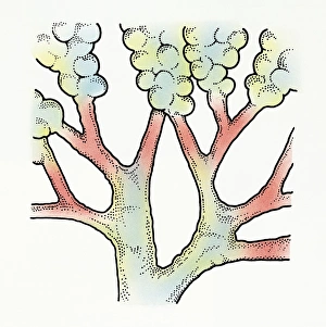 Illustration of inflamed bronchi causing breathing difficulties in childhood Illustration of inflamed bronchi causing breathing difficulties in childhood