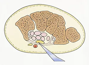 Illustration showing cross section of severed median nerve in wrist caused by sharp piece of glass penetrating skin Illustration showing cross section of severed median nerve in wrist caused by sharp piece of glass penetrating skin
