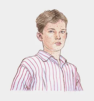 Illustration of teenage boy with chickenpox Illustration of teenage boy with chickenpox