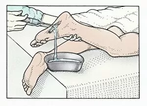 Images Dated 9th December 2008: Illustration of using syringe to clean wound on sole of foot
