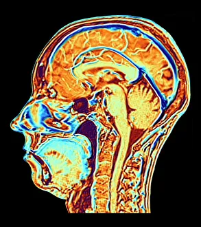 MRI scan of normal brain, illustration MRI scan of normal brain, illustration
