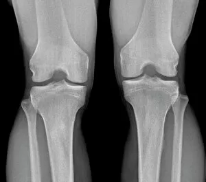Colour Collection: Normal knees, X-ray
