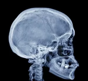 Profile Collection: Normal skull, X-ray