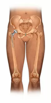 Images Dated 16th March 2010: Front view of a body showing a total hip replacement