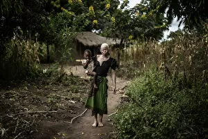 Images Dated 17th April 2015: Malawi-Albinos-Feature