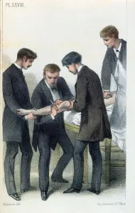Amputating an arm, from a medical manual by Jean-Baptiste-Leon Dubreuil, c Amputating an arm, from a medical manual by Jean-Baptiste-Leon Dubreuil, c