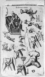 Unknown Artist Prints: 17th Century Print: Surgical Interventions on the Sexes