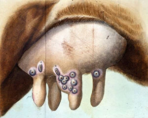 The cow's breast used to inoculate the smallpox vaccine by Luigi Sacco (1769-1836