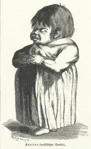 Biochemistry Gallery: Cretin, woman suffering from congenital iodine deficiency syndome (engraving)