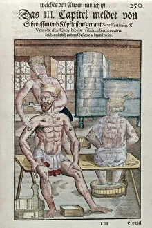 Cupping, from Ophthalmodouleia by Georg Bartisch (1535-1636 Cupping, from Ophthalmodouleia by Georg Bartisch (1535-1636
