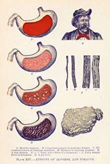 Nerve Gallery: Effects of Alcohol and Tobacco (colour litho)