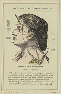 Nerve Gallery: Electrisation du nerf facial, dans un cas de paralysie faciale (colour litho)