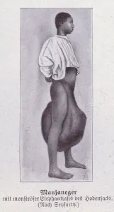 Elephantiasis Collection of Photo Prints and Gifts