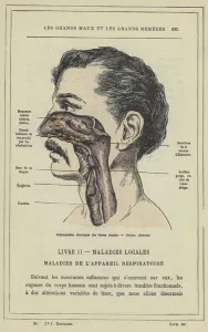 Inflammation chronique de fosses nasales, Coryza ulcereux (colour litho) Inflammation chronique de fosses nasales, Coryza ulcereux (colour litho)