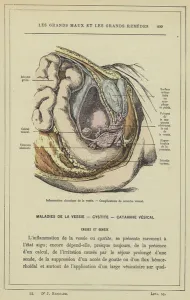 Inflammation chronique de la vessie, Complications du catarrhe vesical (colour litho) Inflammation chronique de la vessie, Complications du catarrhe vesical (colour litho)