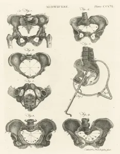Midwifery, illustration from Encyclopedia Britannica, published in Edinburgh Midwifery, illustration from Encyclopedia Britannica, published in Edinburgh