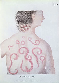 Anatomy & Medical Conditions Gallery: Psoriasis, from a book by Robert Willan (1757-1812) 1808 (coloured engraving)