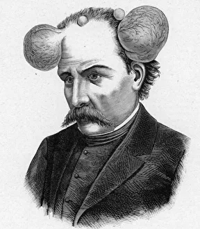 Representation of a person with magnifying glass, scalp cysts (engraving) Representation of a person with magnifying glass, scalp cysts (engraving)