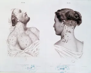 Symptoms of syphilis in men and women, from a medical book, c Symptoms of syphilis in men and women, from a medical book, c