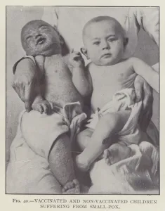Vaccinated and Non-Vaccinated Children Suffering from Small-Pox (b/w photo) Vaccinated and Non-Vaccinated Children Suffering from Small-Pox (b/w photo)