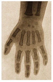 X Ray of a child's hand c.1890