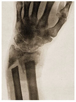 X Ray of a fractured wrist c.1890