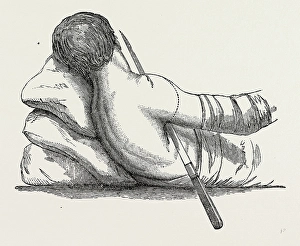 Shoulder Joint Gallery: amputation at the shoulder-joint by transfixion, from fergussons, medical equipment