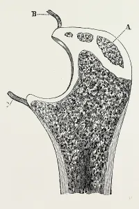 end of the ulna, medical equipment, surgical instrument, history of medicine end of the ulna, medical equipment, surgical instrument, history of medicine