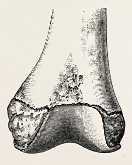 epiphyses of the femur, medical equipment, surgical instrument, history of medicine epiphyses of the femur, medical equipment, surgical instrument, history of medicine