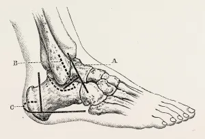 excision of astragalus, outer incision, medical equipment, surgical instrument, history excision of astragalus, outer incision, medical equipment, surgical instrument, history